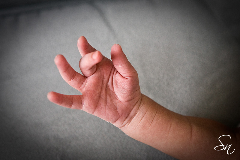 Why do physicians check the palmar lines of newborn babies?